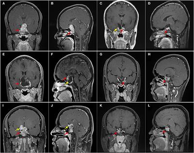 Microscopic Transsphenoidal Resection of Giant Pituitary Adenomas: Analysis of the Factors Limiting the Degree of Resection in 73 Cases